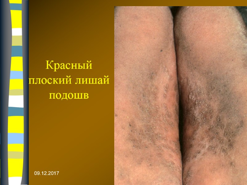 09.12.2017 Красный плоский лишай подошв